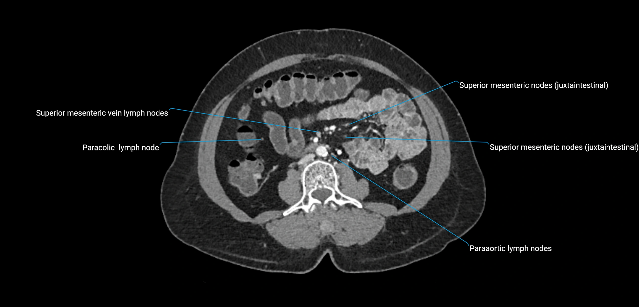 CT ct abdominal lymph nodes  axial cross sectional anatomy  enchanced radiology image -img-00002-00235.webp